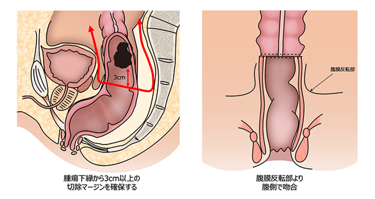 直腸がん標準手術
