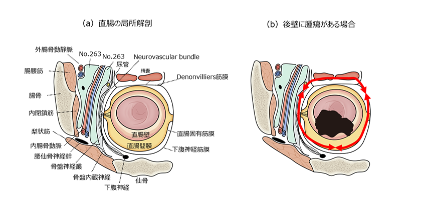 神経温存と合併切除