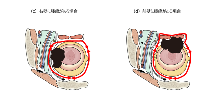 神経温存と合併切除