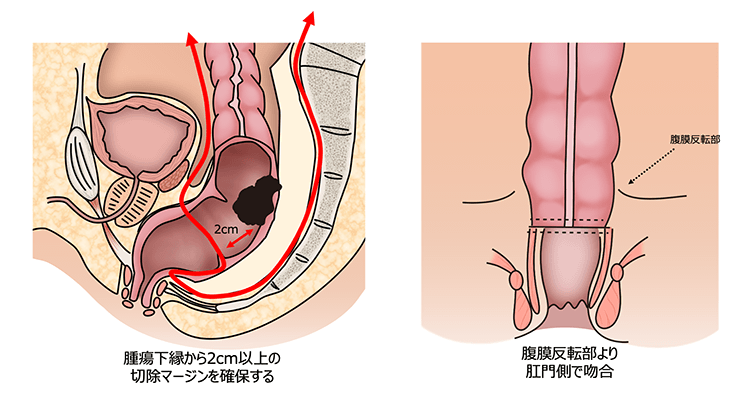 低位前方切除術