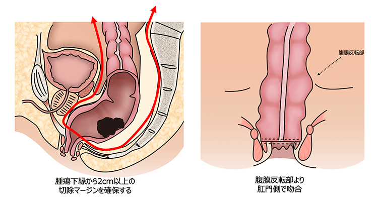 超低位前方切除術