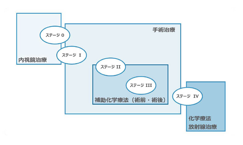 ステージ（病期）と治療
