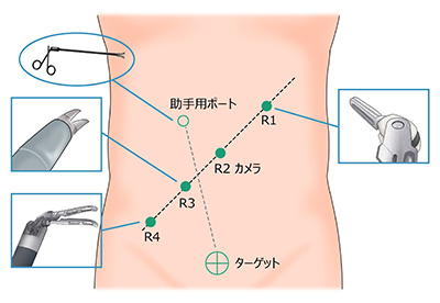 大阪国際がんセンター　大腸外科 大腸癌、直腸癌、結腸癌、手術、ロボット手術、腹腔鏡手術、低侵襲手術、手術手順、手術方法、術式、吻合方法、R1〜R4にロボット用ポートを入れます。ロボットとドッキング後にポートからカメラやインストゥルメント（鉗子、ハサミ型の電気メス、自動縫合器など）入れます。助手は腹腔鏡用の鉗子でサポートします。