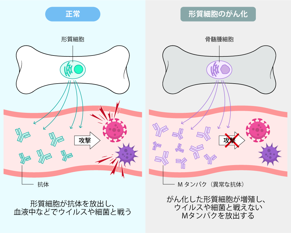 多発性骨髄腫