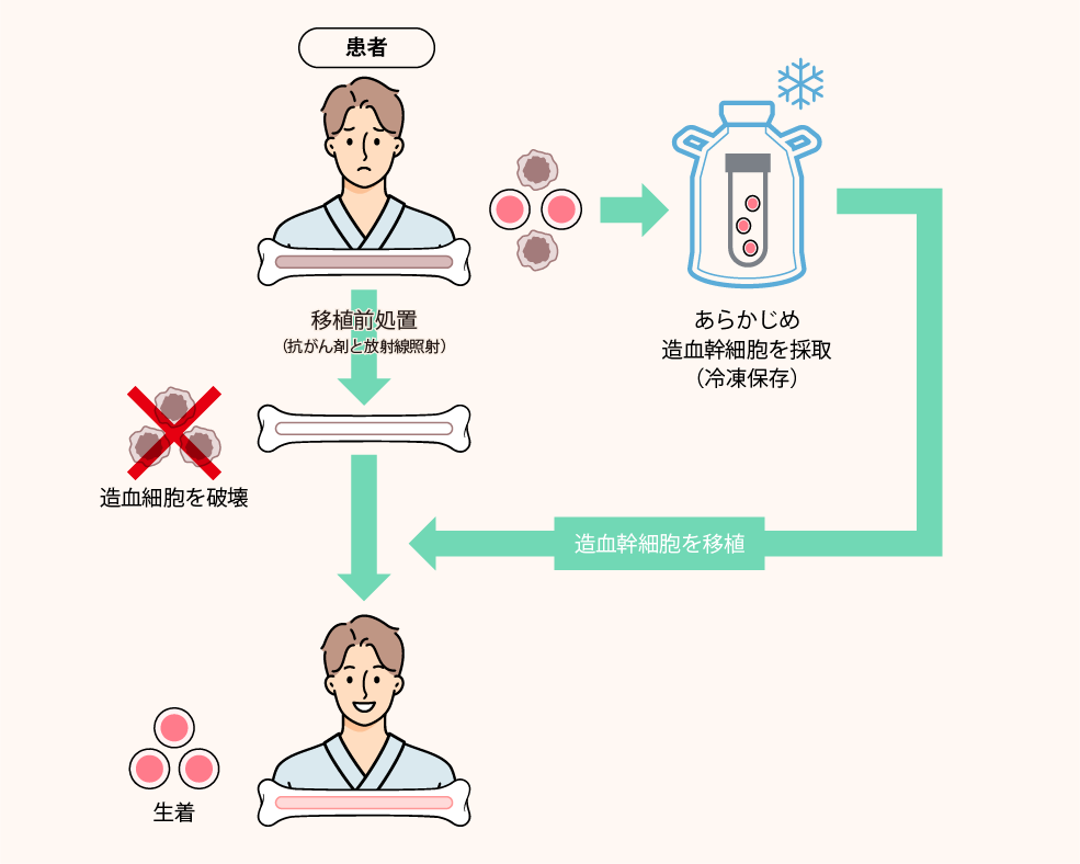 自家末梢血幹細胞移植